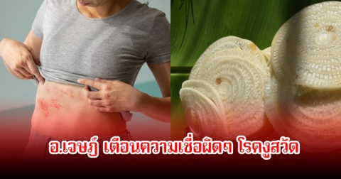 อ.เจษฎ์ เตือนความเชื่อผิดๆ โรคงูสวัด อย่าหลงเชื่อเด็ดขาด