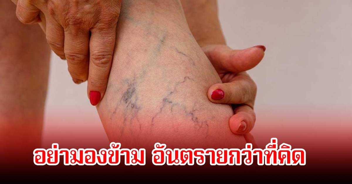 หมอเตือนเอง อาการเปลี่ยนแปลงของร่างกาย อันตรายอย่ามองข้าม อาจถึงขั้นตัดขา พบหลายคนทำพฤติกรรมเสี่ยงทุกวัน