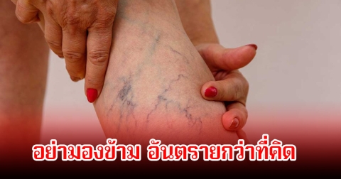 หมอเตือนเอง อาการเปลี่ยนแปลงของร่างกาย อันตรายอย่ามองข้าม อาจถึงขั้นตัดขา พบหลายคนทำพฤติกรรมเสี่ยงทุกวัน