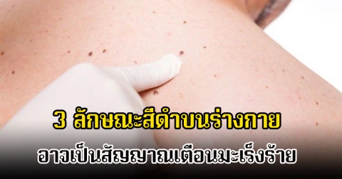 อย่าชะล่าใจ! 3 ลักษณะสีดำบนร่างกาย ไม่ใช่แค่ไฝหรือขี้แมลงวัน อาจเป็นสัญญาณเตือนมะเร็งร้าย