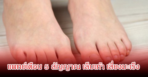 แพทย์เตือน 5 สัญญาณ เล็บเท้า เสี่ยงมะเร็ง อาการเล็กๆที่หลายคนชอบมองข้าม
