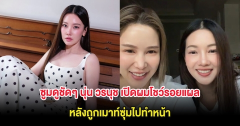 ซูมดูชัดๆ นุ่น วรนุช เปิดผมโชว์รอยแผล หลังถูกเมาท์ซุ่มไปทำหน้า