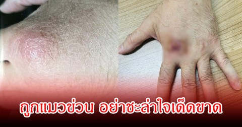 หมอเตือน! ถูกแมวข่วน อย่าชะล่าใจ หลังพบคนไข้ จากแผลเล็กๆกลายเป็นตุ่มนูน ซ้ำติดเชื้อราอีก