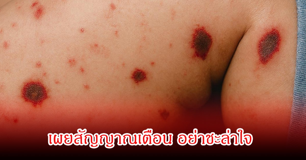 หมอเจด  เปิด 5 เรื่องเกี่ยวกับไข้กาฬหลังแอ่น อันตรายถึงชีวิต เผยสัญญาณเตือน อย่าชะล่าใจ