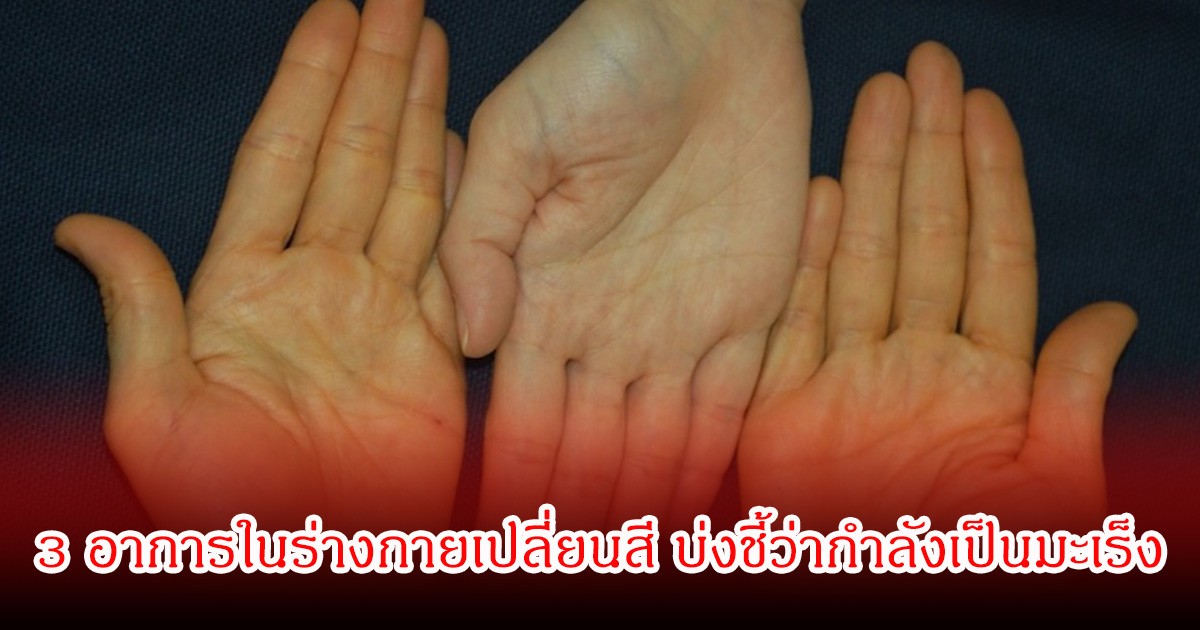 สัญญาณมรณะ! 3 อาการในร่างกายเปลี่ยนสี บ่งชี้ว่ากำลังเป็นมะเร็ง หลายคนเป็นไม่รู้