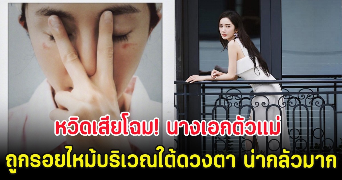 หวิดเสียโฉม! นางเอกตัวแม่ ถูกรอยไหม้บริเวณใต้ดวงตา น่ากลัวมาก (ตปท.)