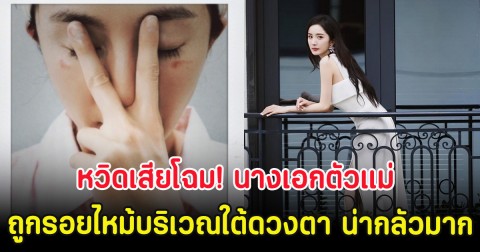 หวิดเสียโฉม! นางเอกตัวแม่ ถูกรอยไหม้บริเวณใต้ดวงตา น่ากลัวมาก (ตปท.)