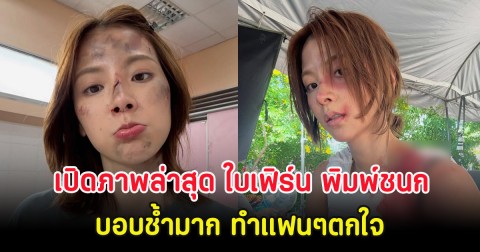 เปิดภาพล่าสุด ใบเฟิร์น พิมพ์ชนก บอบช้ำมาก ทำแฟนๆตกใจ
