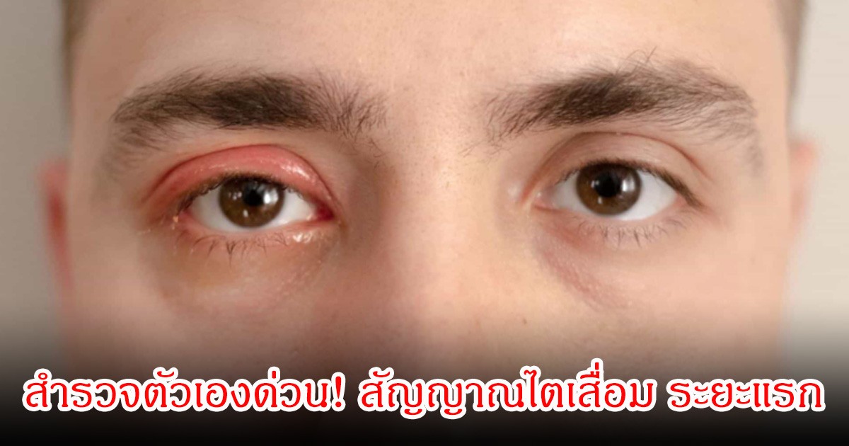 สำรวจตัวเองด่วน! สัญญาณไตเสื่อม ระยะแรก ที่ไม่ควรมองข้ามเด็ดขาด