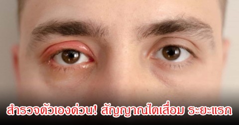 สำรวจตัวเองด่วน! สัญญาณไตเสื่อม ระยะแรก ที่ไม่ควรมองข้ามเด็ดขาด