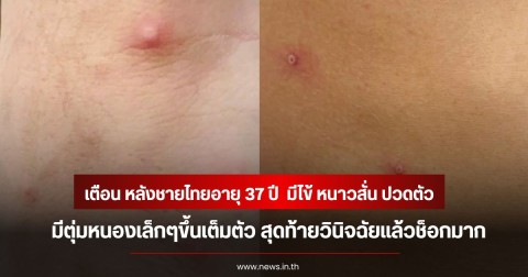 หมอมนูญ ออกมาเตือน หลังชายไทยอายุ 37 ปี  มีไข้ หนาวสั่น ปวดตัว มีตุ่มหนองเล็กๆขึ้นเต็มตัว สุดท้ายวินิจฉัยแล้วช็อกมาก