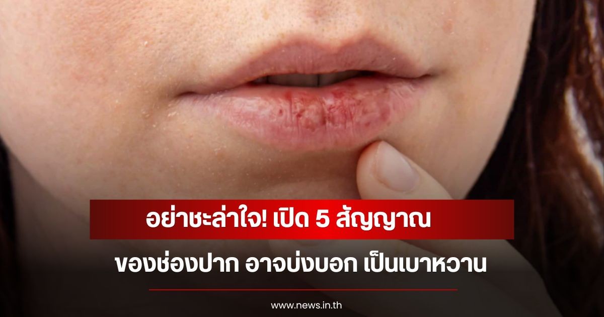 อย่าชะล่าใจ! เปิด 5 สัญญาณของช่องปาก อาจบ่งบอก เป็นเบาหวาน