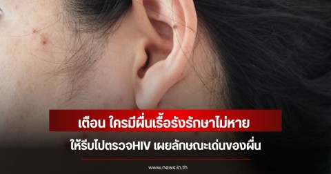 เตือน ใครมีผื่นเรื้อรังรักษาไม่หาย ให้รีบไปตรวจHIV เผยลักษณะเด่นของผื่น