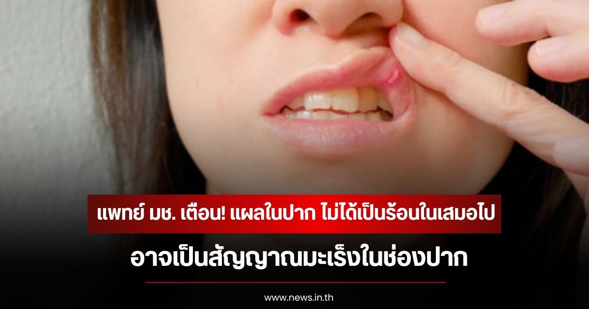 แพทย์ มช. เตือน! แผลในปาก ไม่ได้เป็นร้อนในเสมอไป อาจเป็นสัญญาณมะเร็งในช่องปาก