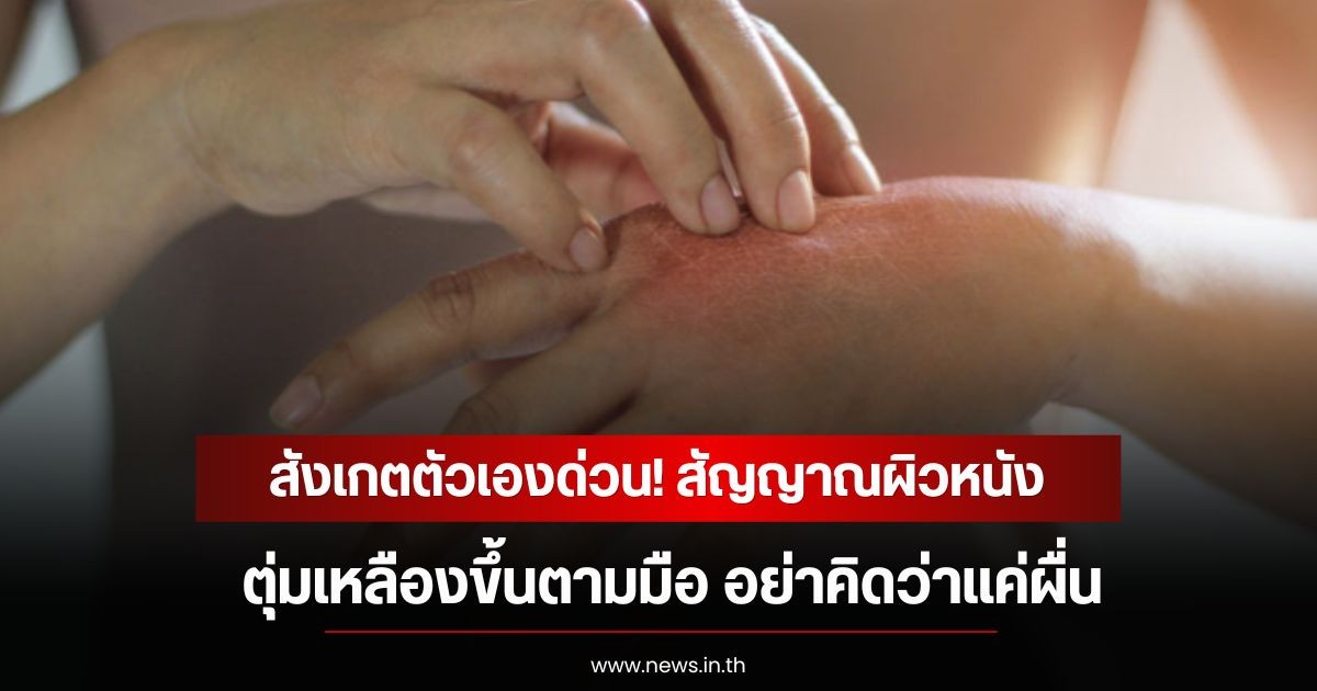 สังเกตตัวเองด่วน! สัญญาณผิวหนังตุ่มเหลืองขึ้นตามมือ อย่าคิดว่าแค่ผื่น