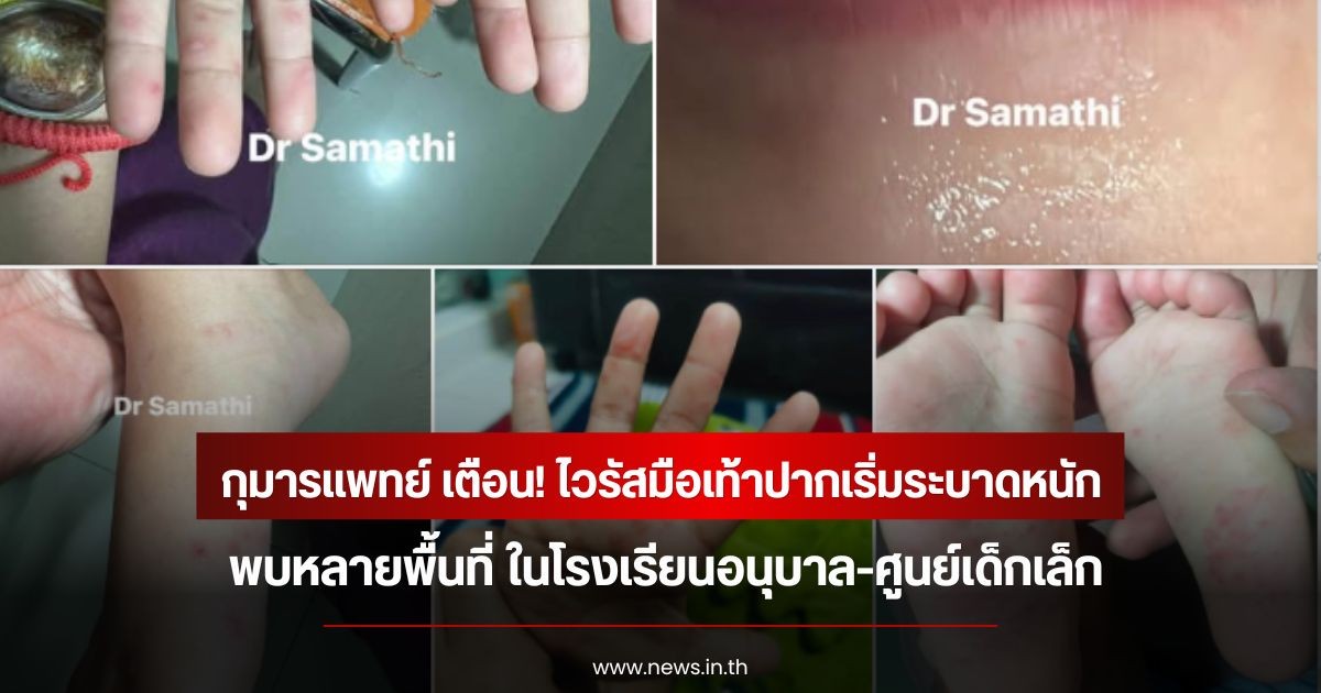 กุมารแพทย์ เตือน! ไวรัสมือเท้าปากเริ่มระบาดหนัก พบหลายพื้นที่ ในโรงเรียนอนุบาล-ศูนย์เด็กเล็ก