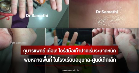 กุมารแพทย์ เตือน! ไวรัสมือเท้าปากเริ่มระบาดหนัก พบหลายพื้นที่ ในโรงเรียนอนุบาล-ศูนย์เด็กเล็ก