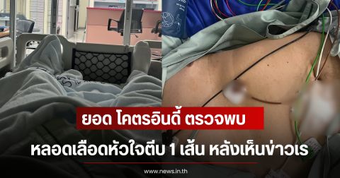 ยอด โคตรอินดี้ ตรวจพบ หลอดเลือดหัวใจตีบ 1 เส้น หลังเห็นข่าวเร แม๊คโดนัลด์