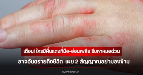 แพทย์เตือน! ใครมีผื่นแดงที่มือ-อ่อนเพลีย รีบหาหมอด่วน อาจอันตรายถึงชีวิต  เผย 2 สัญญาณอย่ามองข้าม
