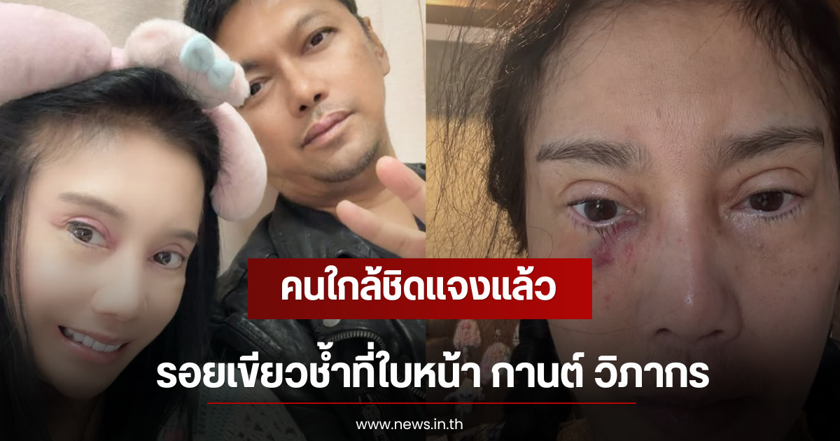 คนใกล้ชิดแจงแล้ว รอยเขียวช้ำที่ใบหน้า กานต์ วิภากร