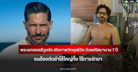 พระเอกฮอลลีวูดดัง เปิดภาพวิกฤตชีวิต ป่วยปริศนานาน 7 ปี จนต้องตัดลำไส้ใหญ่ทิ้ง ไร้ทางรักษา